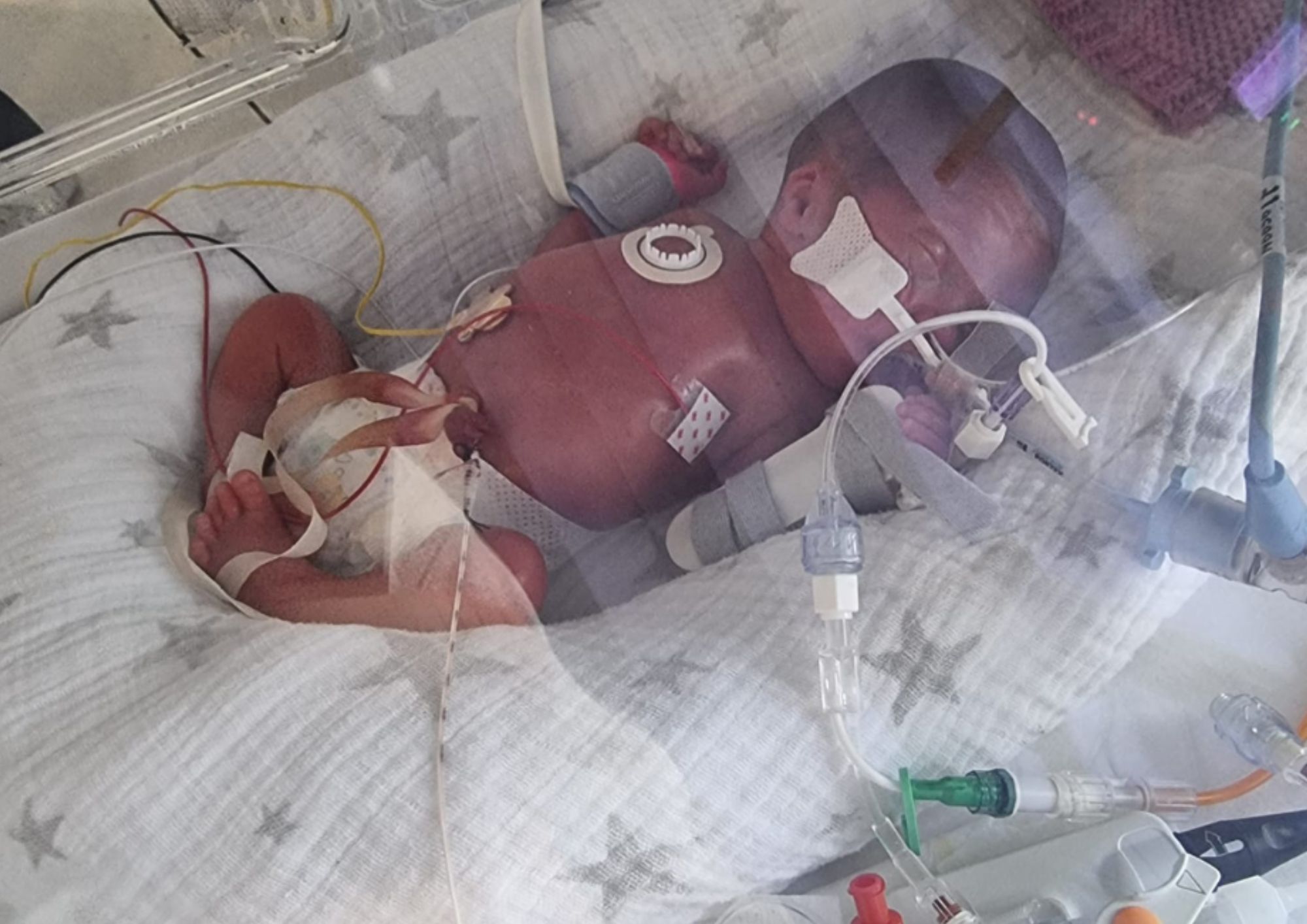 a premature baby in NICU